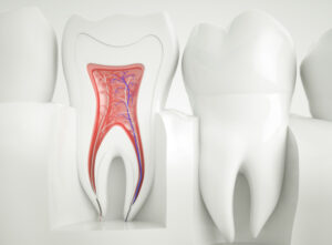 illustrazione di un dente da devitalizzare con polpa dentale e canali radicolari evidenziati