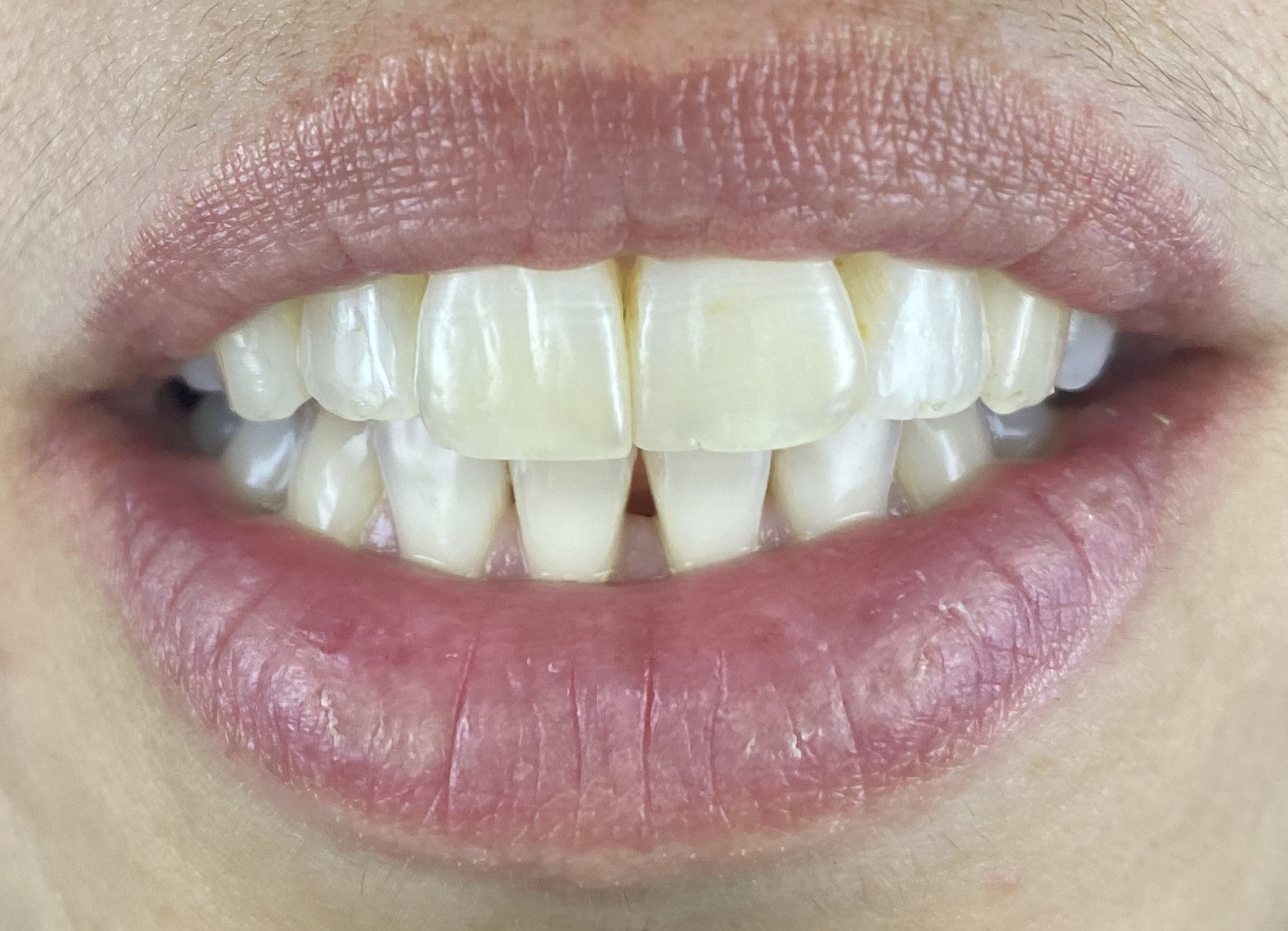 After-Trattamento Invisalign