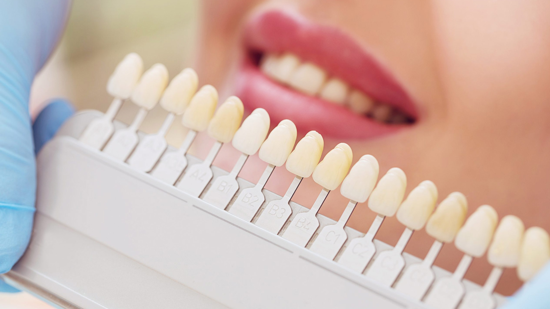 Faccette dentali: le 10 domande più frequenti tra dubbi e falsi miti