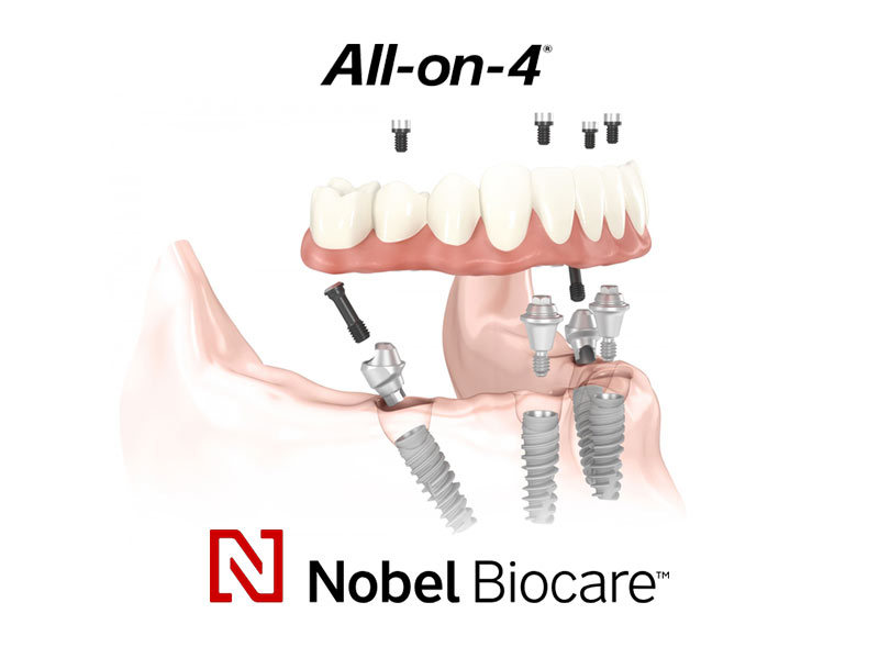 all-on-4-nobel-biocare-roma