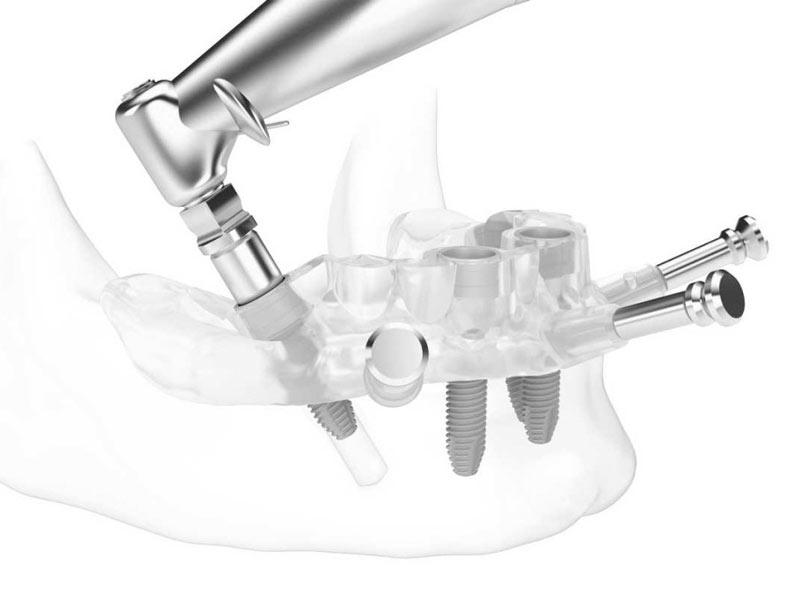 all-on-four-implantologia-dentale-roma