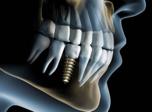 Impianto dentale a Roma: quanto dura e quando serve impianto dentale inserito nell’osso mandibolare per sostituire un dente mancante