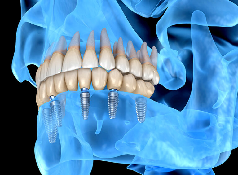 Quanto costa un impianto dentale a Roma riabilitazione dentale con impianti inseriti nell’osso per sostituire denti mancanti