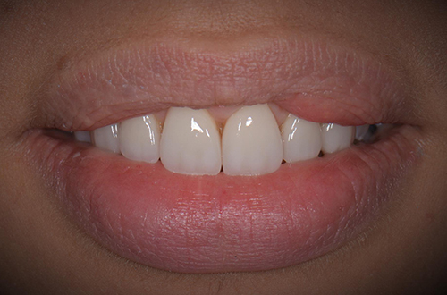 After-Faccette Dentali