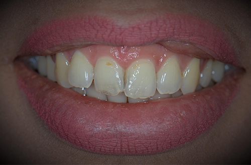 Before-Faccette Dentali