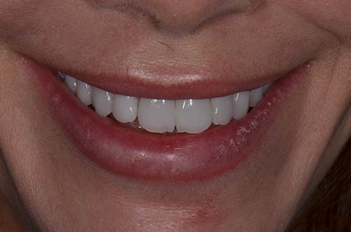After-Faccette Dentali