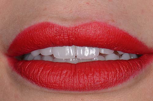 After-Faccette Dentali