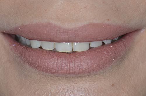 Before-Faccette Dentali