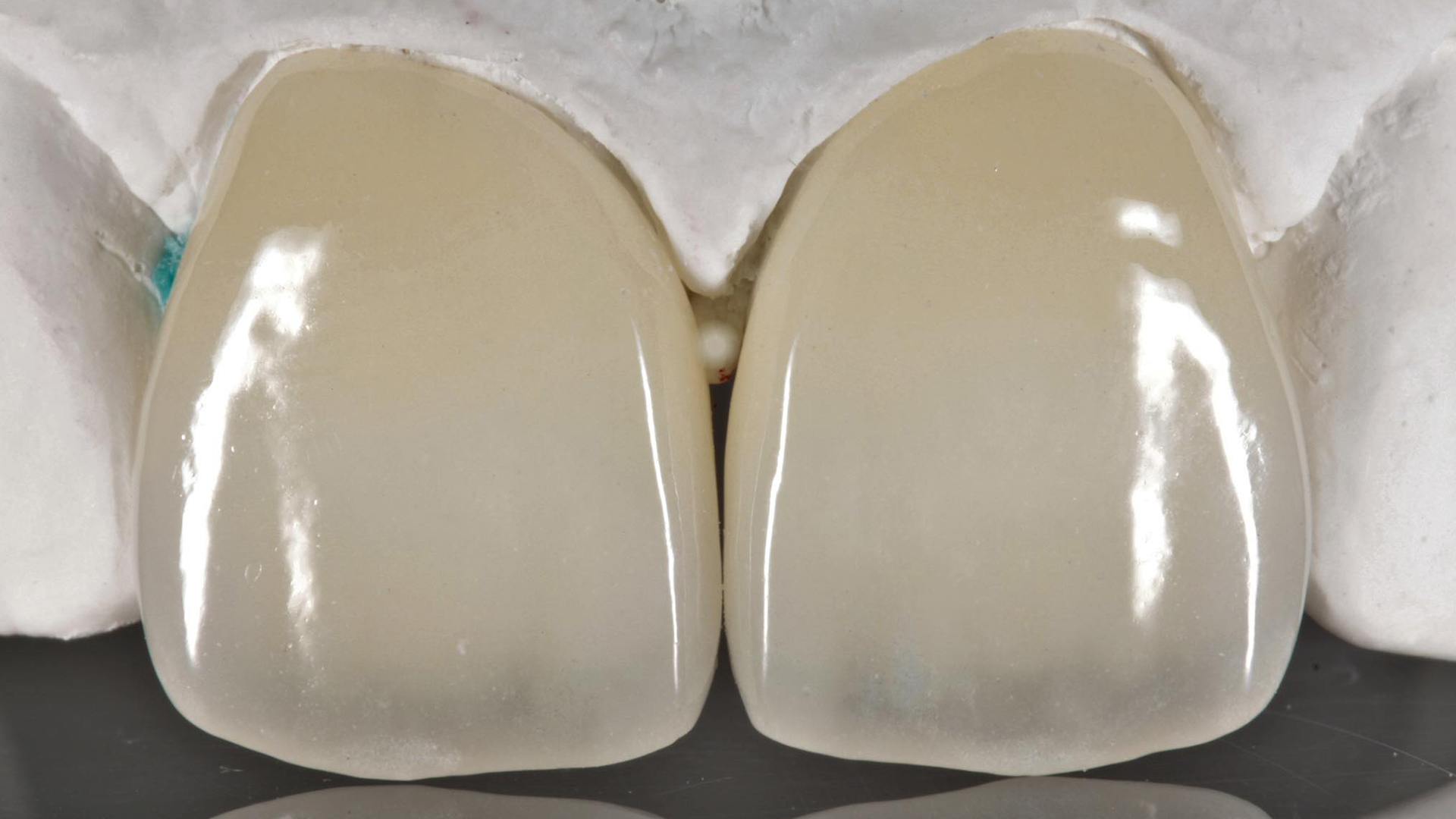I migliori materiali per faccette dentali: quali scegliere?