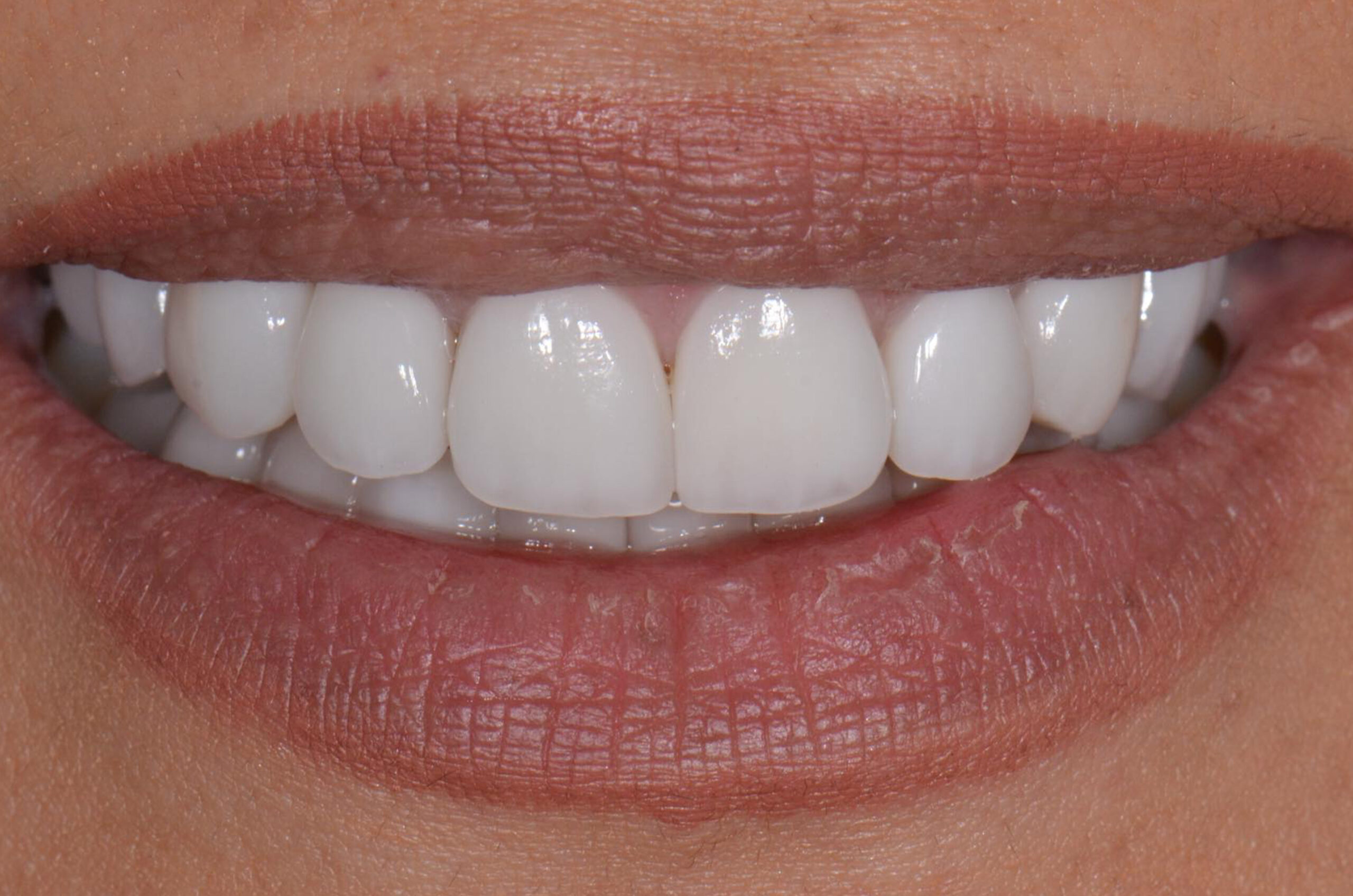 After-Invisalign e Faccette