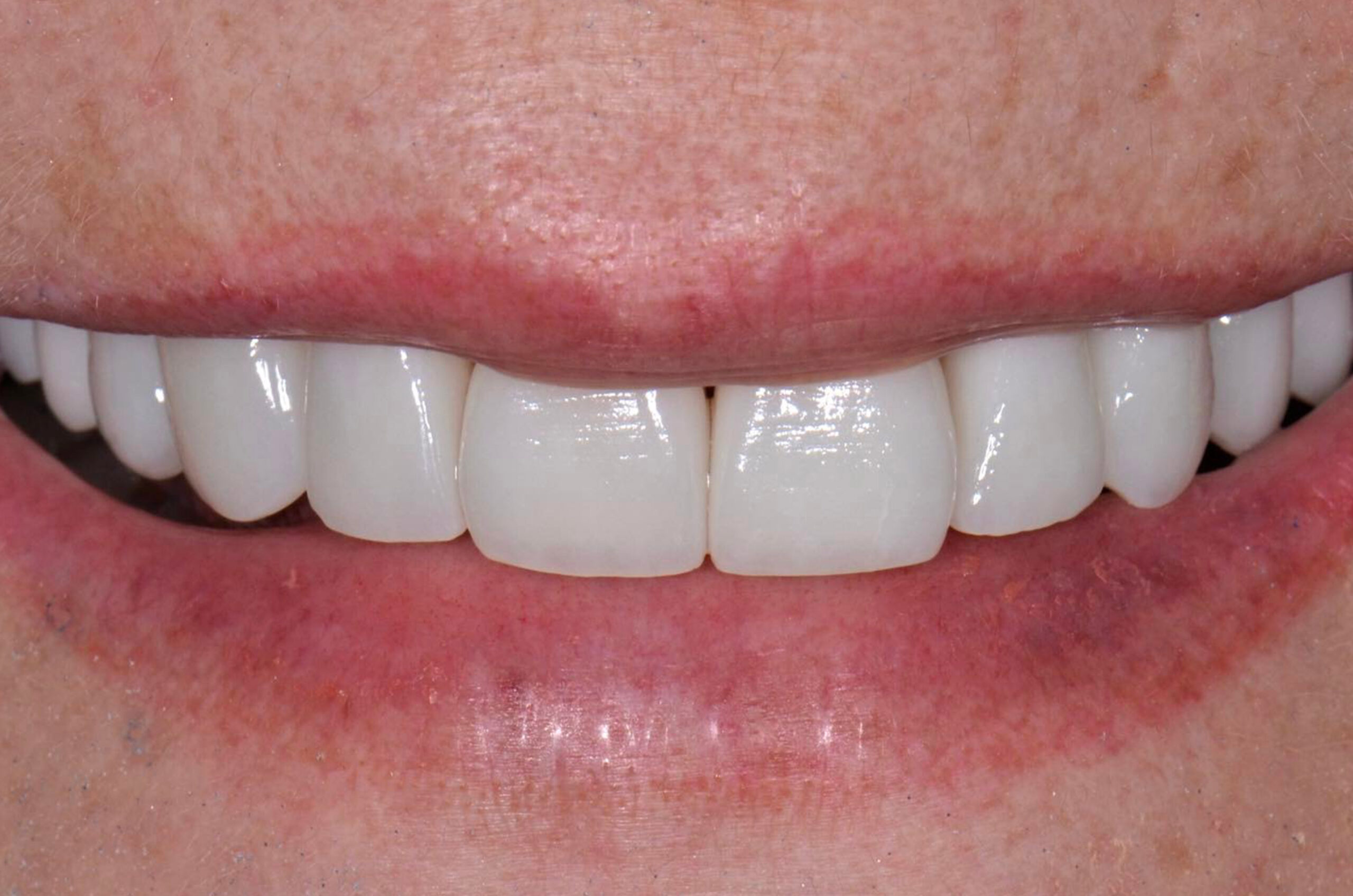 After-Faccette Dentali