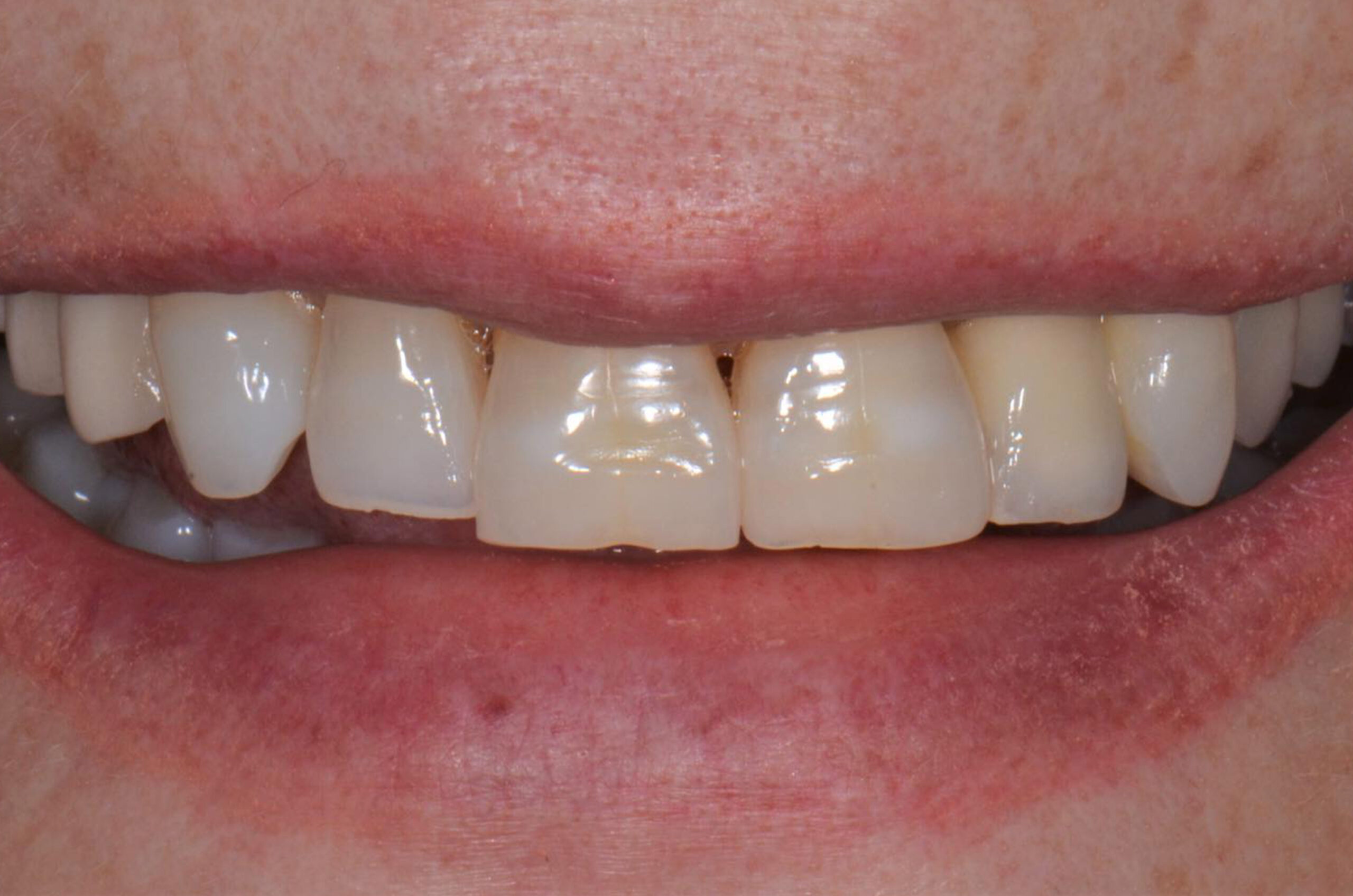 Before-Faccette Dentali