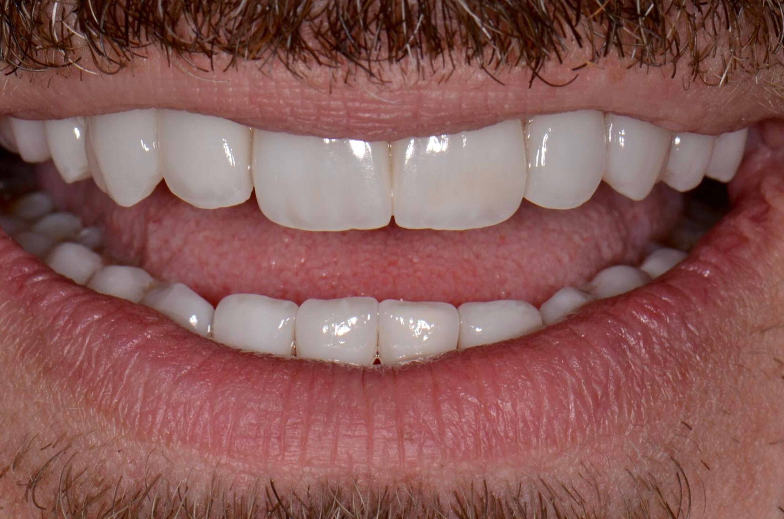 After-Invisalign e Faccette