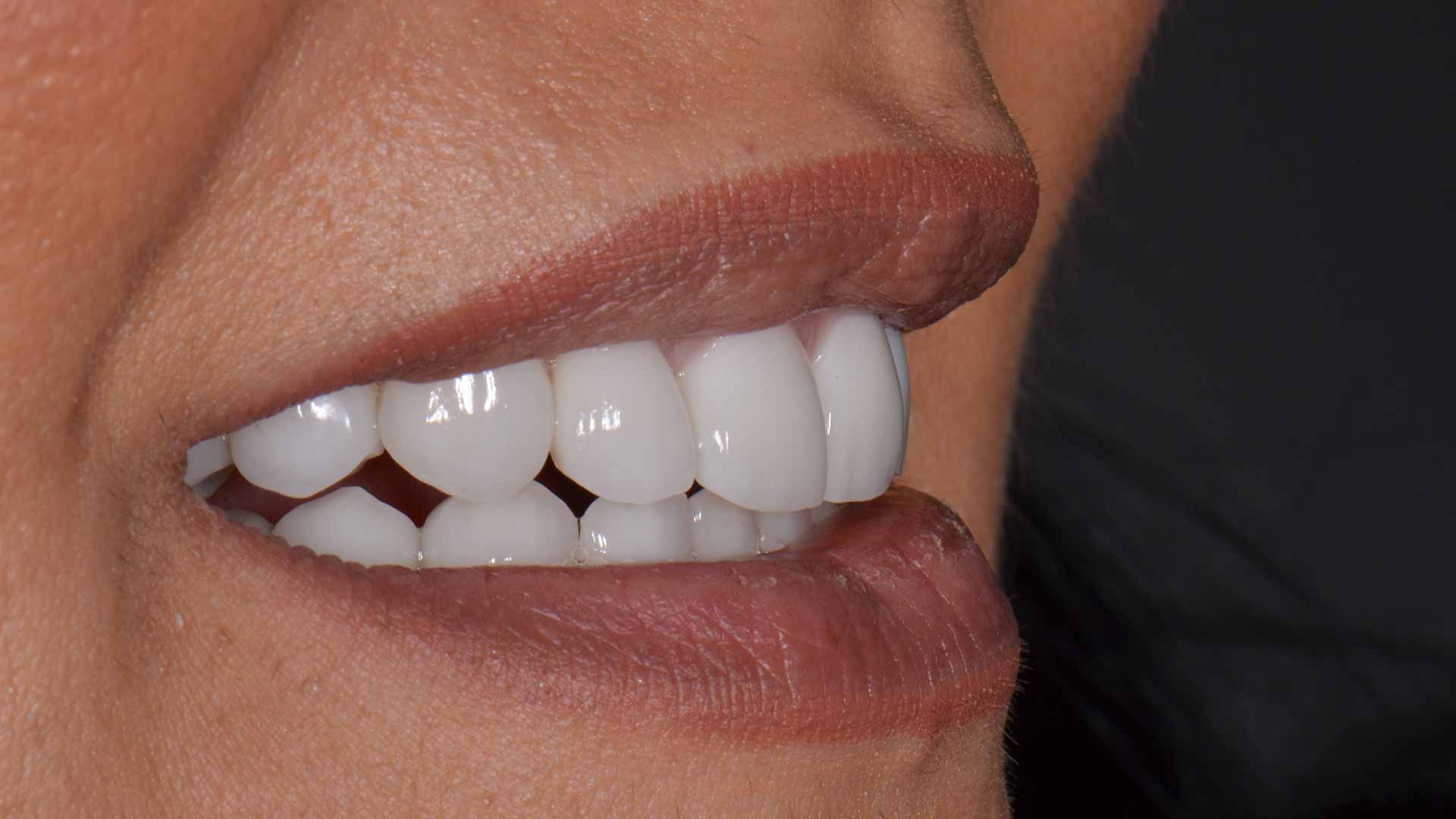 Faccette Dentali: Vantaggi, Rischi e Cautelative da Considerare