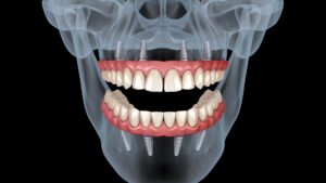 Denti Fissi con Carico Immediato: Una Soluzione Veloce e Duratura