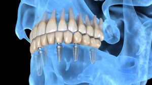 Implantologia Dentale a Carico Immediato: Ripristina il tuo Sorriso