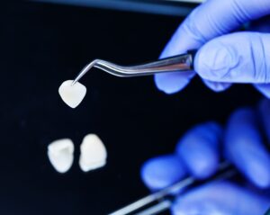 Faccette dentali a Roma: quando servono e quanto durano faccette dentali in ceramica utilizzate per migliorare estetica e forma dei denti